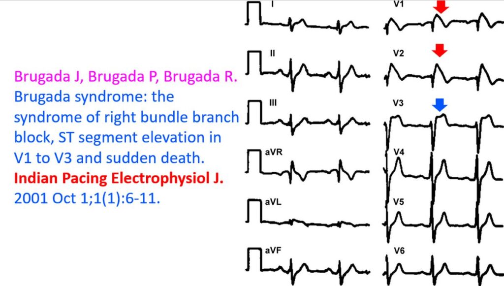 Brugada Syndrome: Diagnosis and Risk Stratification – All About ...