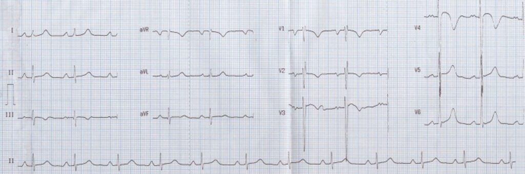 Collection of a few ECGs in congenital heart diseases - All About ...