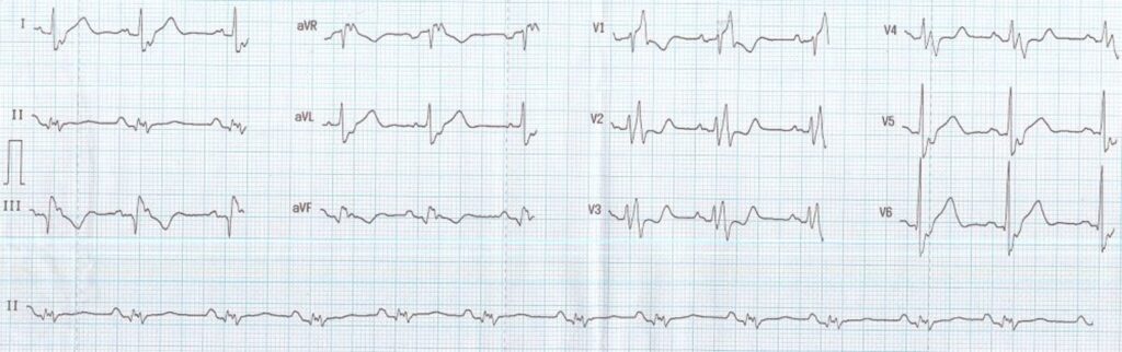 Collection of a few ECGs in congenital heart diseases – All About ...