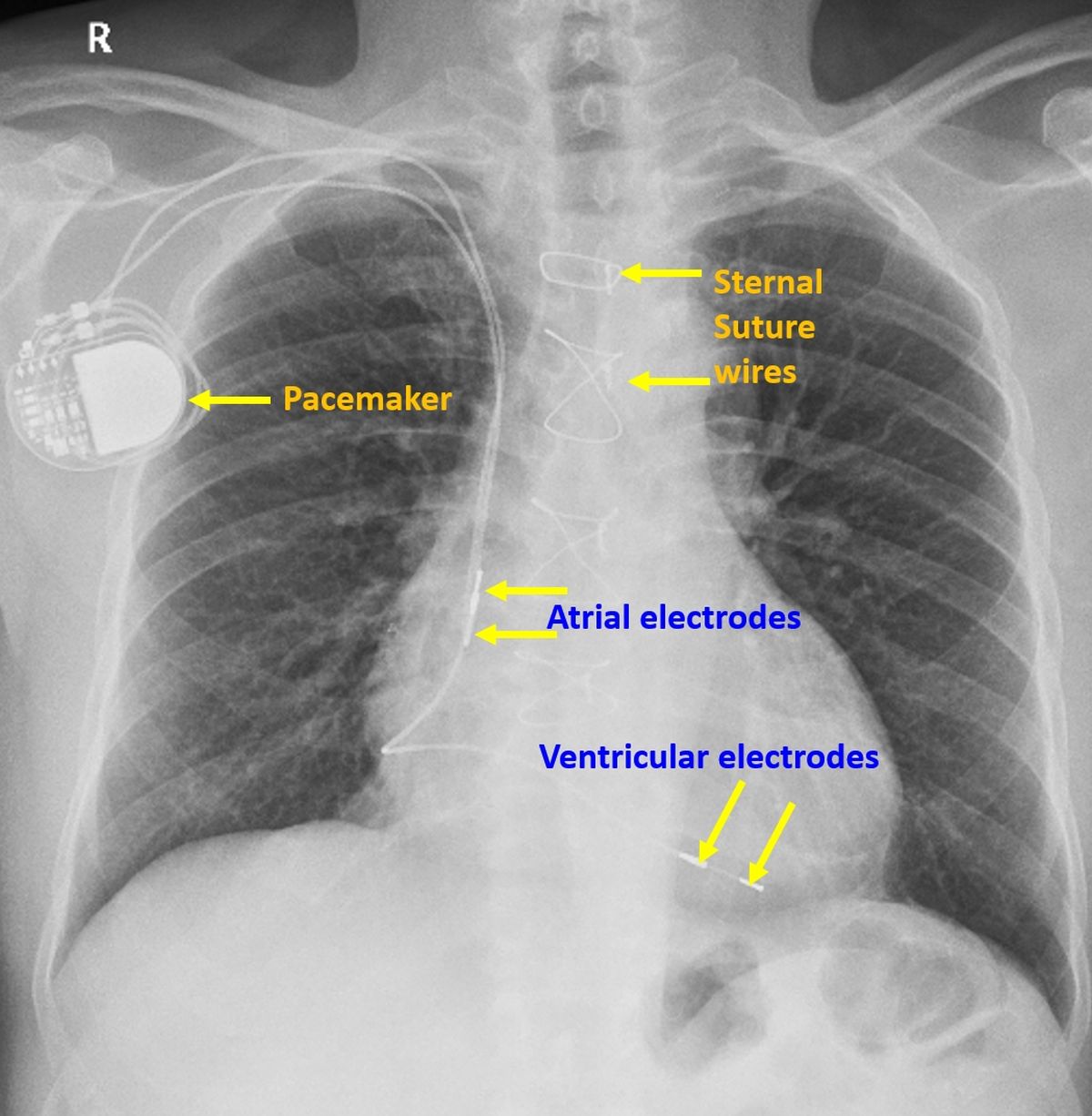 Biventricular Pacemaker Chest X Ray 1080x1080