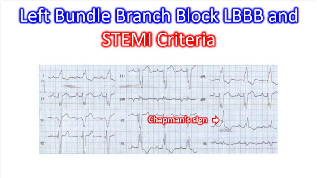 Left Bundle Branch Block LBBB and STEMI Criteria