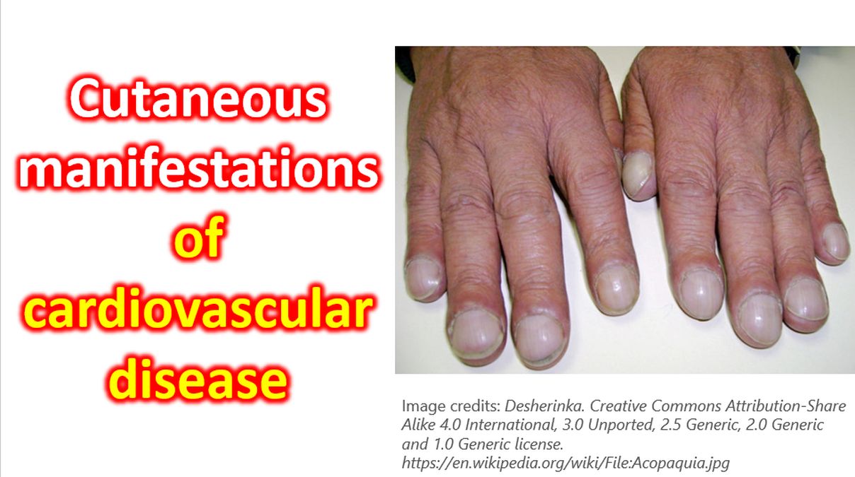 Cutaneous manifestations of cardiovascular disease - All About ...